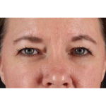 Brow Lift Before & After Patient #1566
