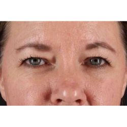 Brow Lift Before & After Patient #1566