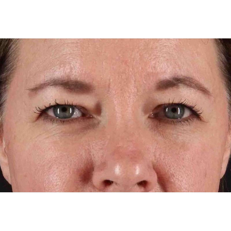 Brow Lift Before & After Patient #1566