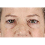 Brow Lift Before & After Patient #1577