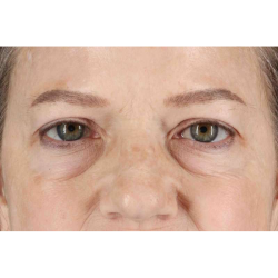 Brow Lift Before & After Patient #1577