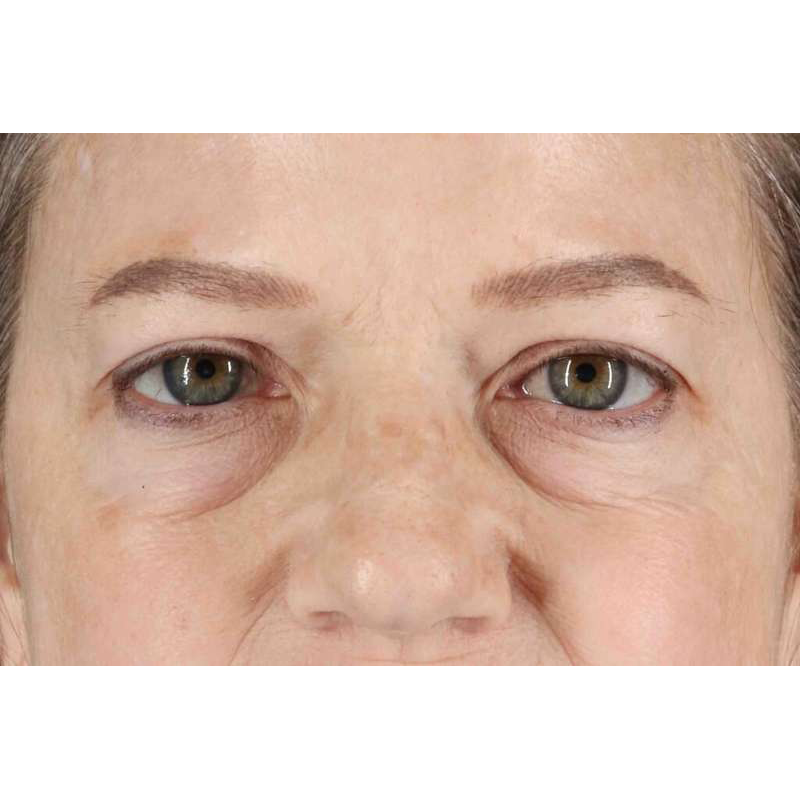 Brow Lift Before & After Patient #1577