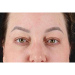 Brow Lift Before & After Patient #1588
