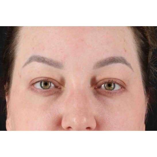 Brow Lift Before & After Patient #1588