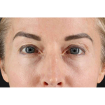 Laser Before & After Patient #2070