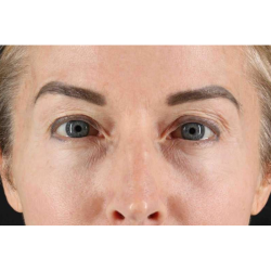 Laser Before & After Patient #2070