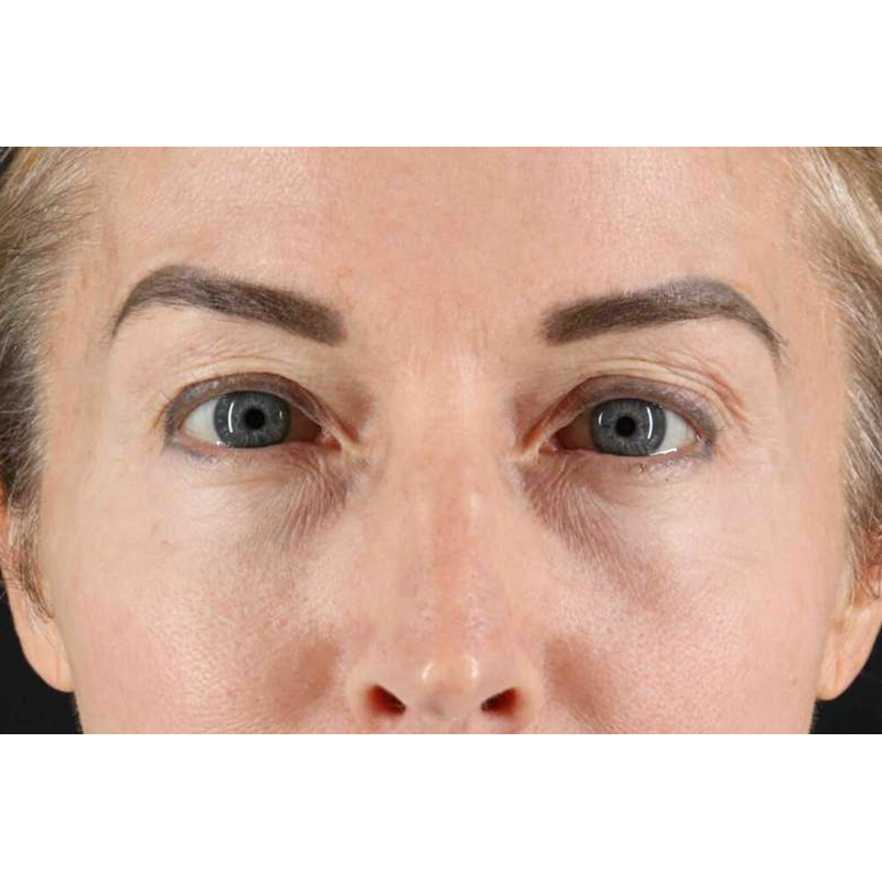 Laser Before & After Patient #2070