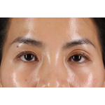 Eyelid Surgery Before & After Patient #1935