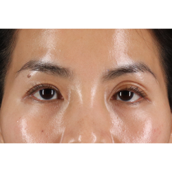 Eyelid Surgery Before & After Patient #1935