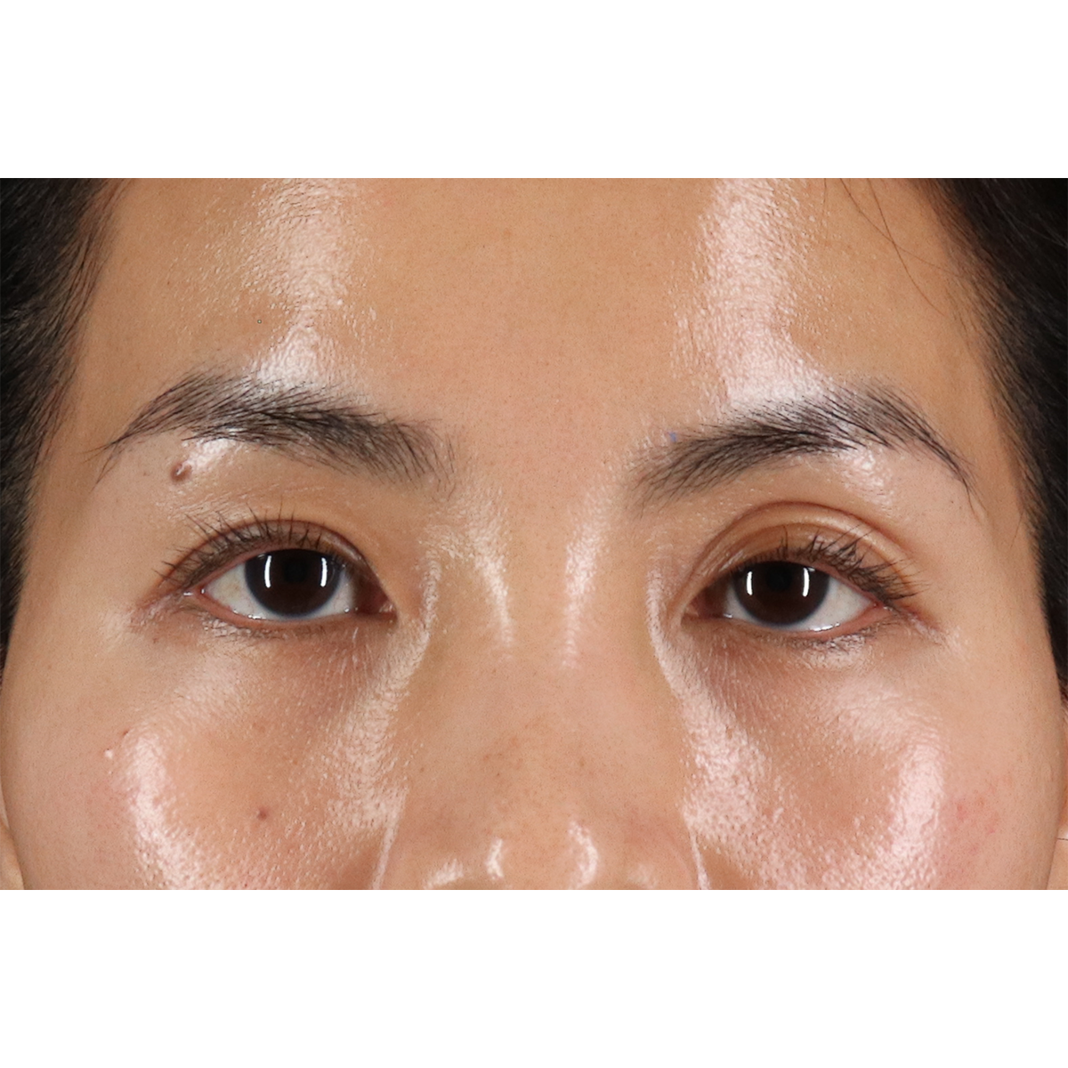 Eyelid Surgery Before & After Patient #1935