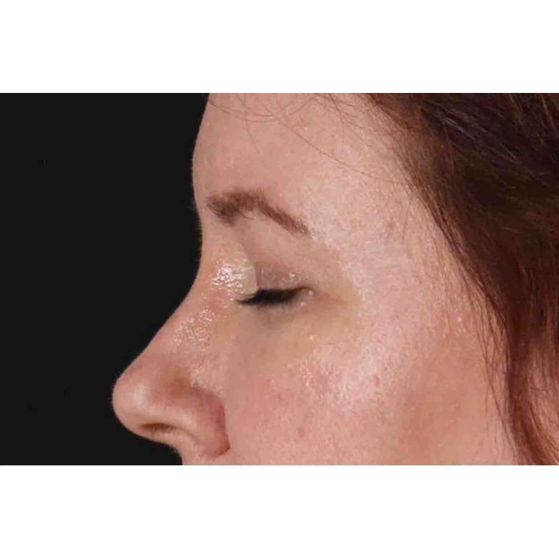 Brow Lift Before & After Patient #1566