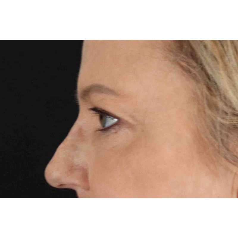 Brow Lift Before & After Patient #1577