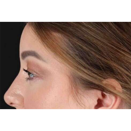 Brow Lift Before & After Patient #1588