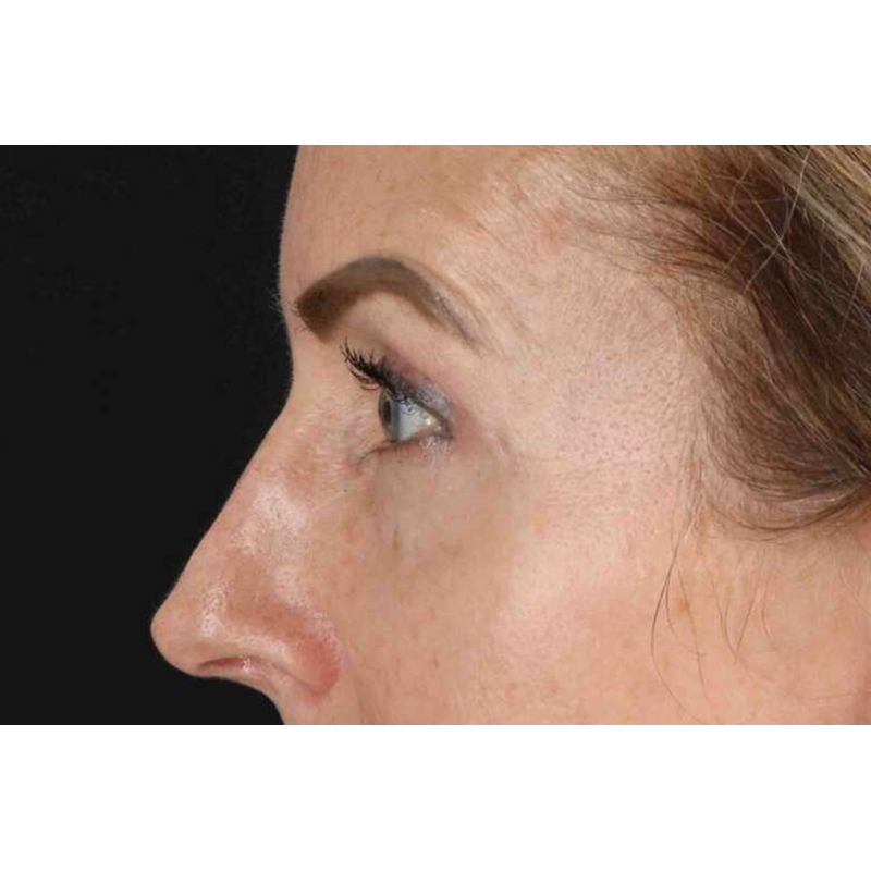 Laser Before & After Patient #2070