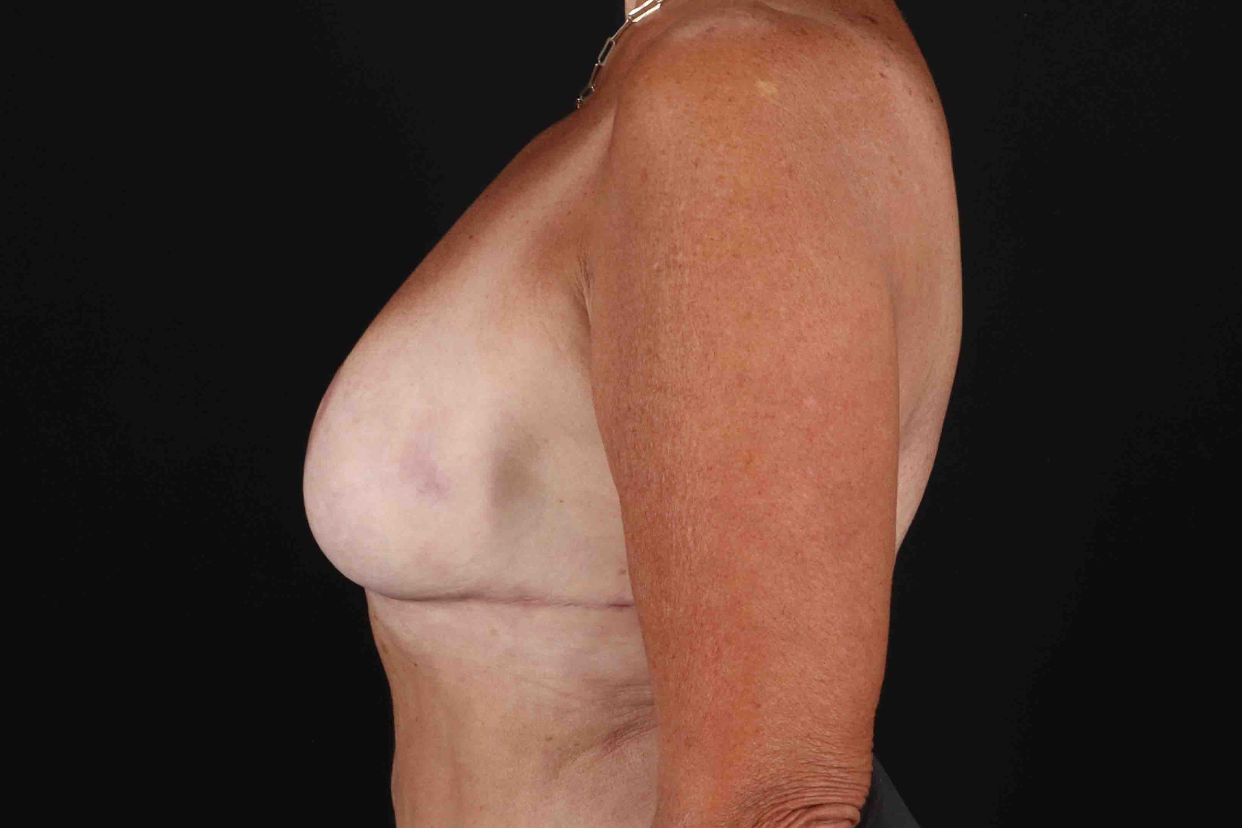 Breast Reduction with Lift Before & After Patient #1016
