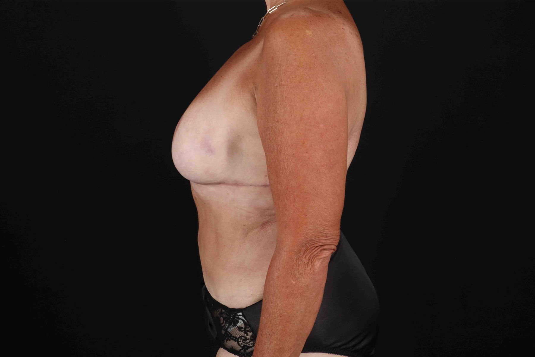 Mommy Makeover Before & After Patient #1353