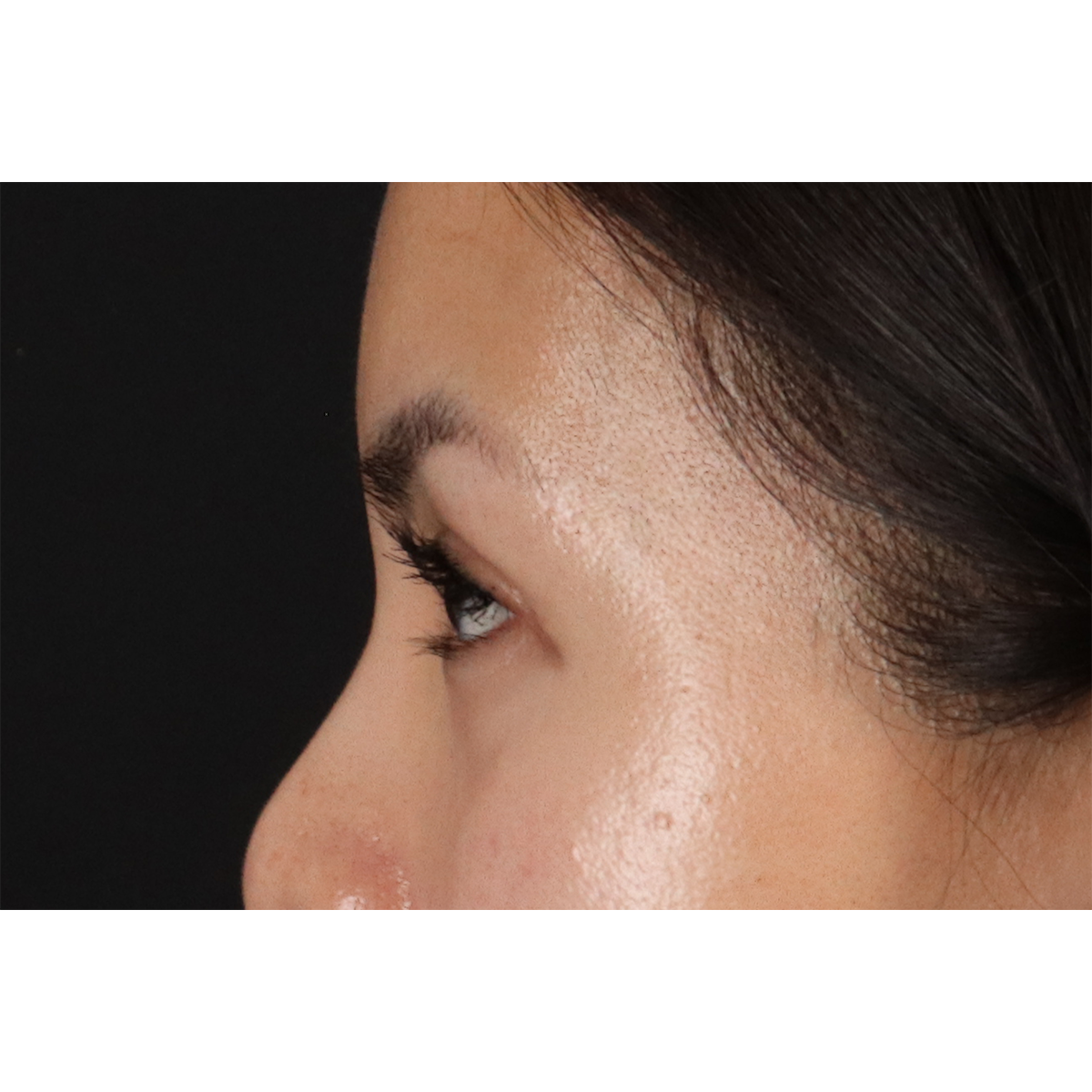 Eyelid Surgery Before & After Patient #1935