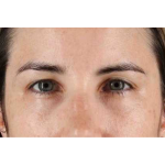 Brow Lift Before & After Patient #1599