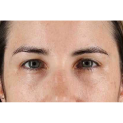 Brow Lift Before & After Patient #1599