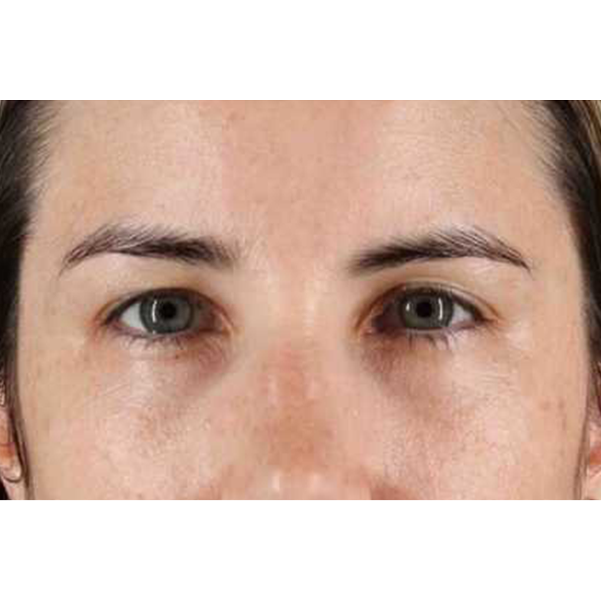 Brow Lift Before & After Patient #1599