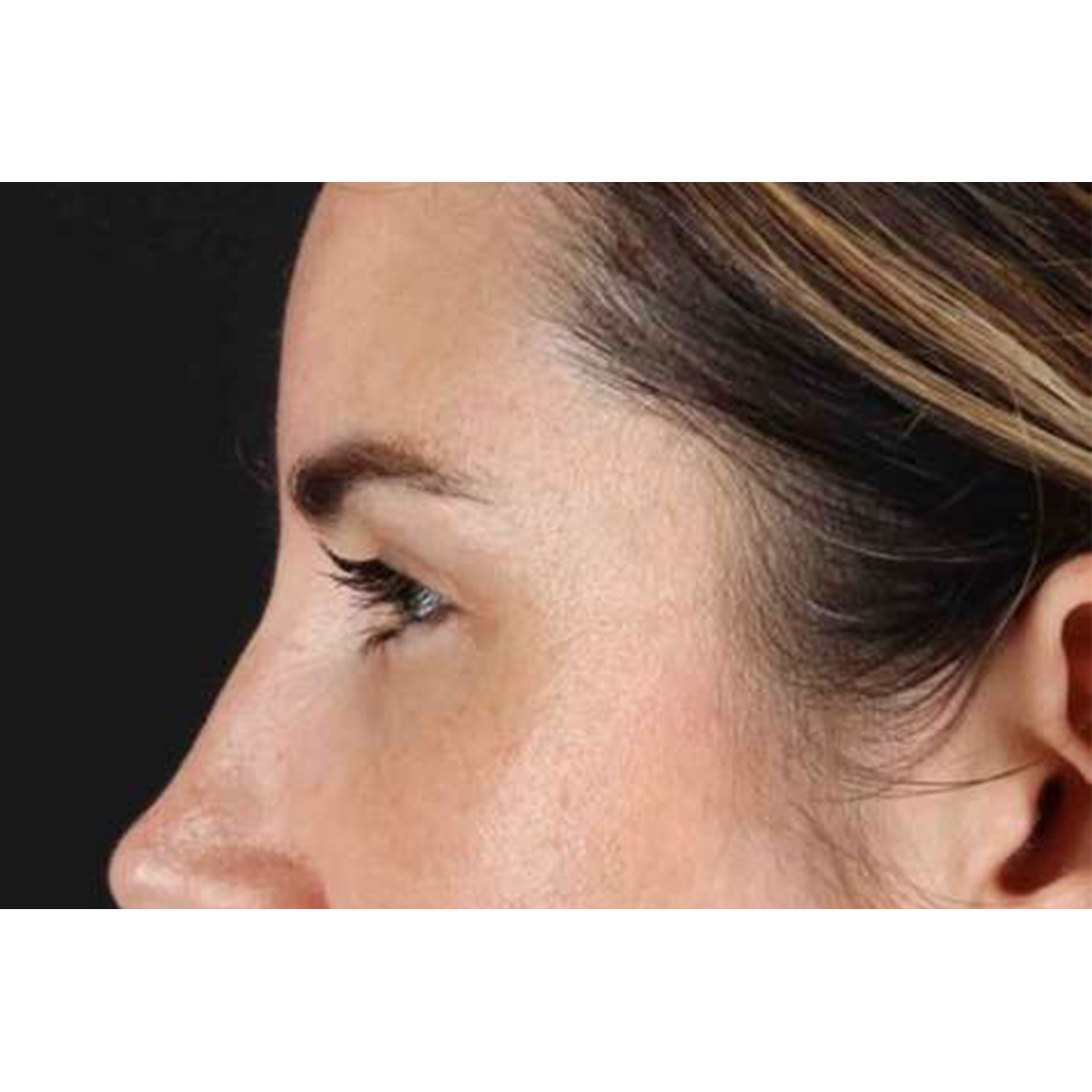 Brow Lift Before & After Patient #1599