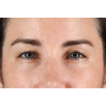 Brow Lift Before & After Patient #1599