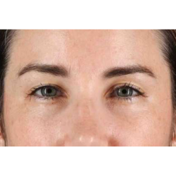 Brow Lift Before & After Patient #1599