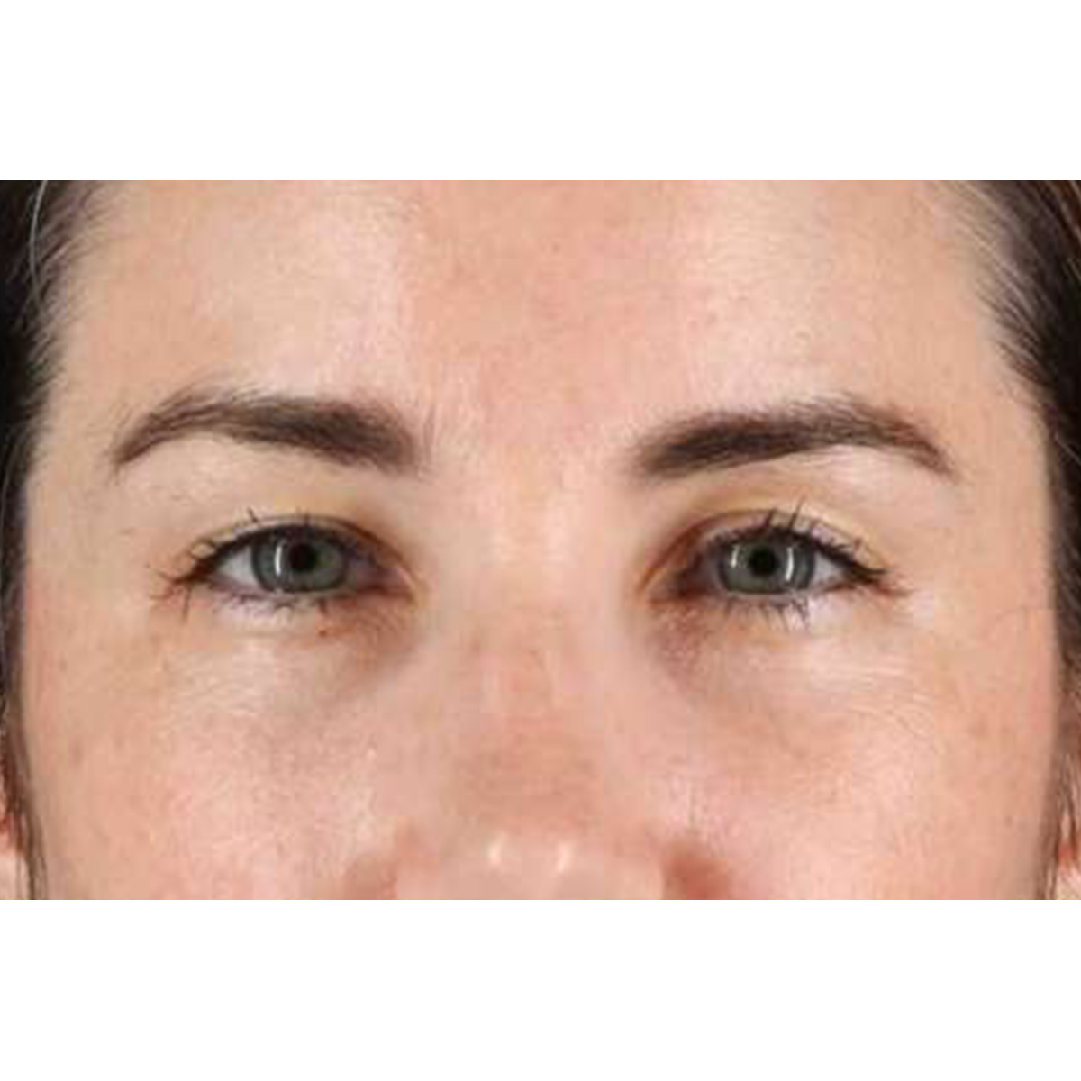 Brow Lift Before & After Patient #1599