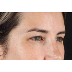 Brow Lift Before & After Patient #1599