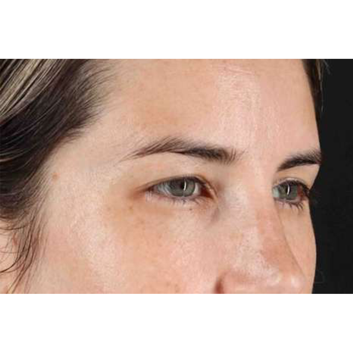 Brow Lift Before & After Patient #1599