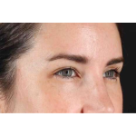 Brow Lift Before & After Patient #1599