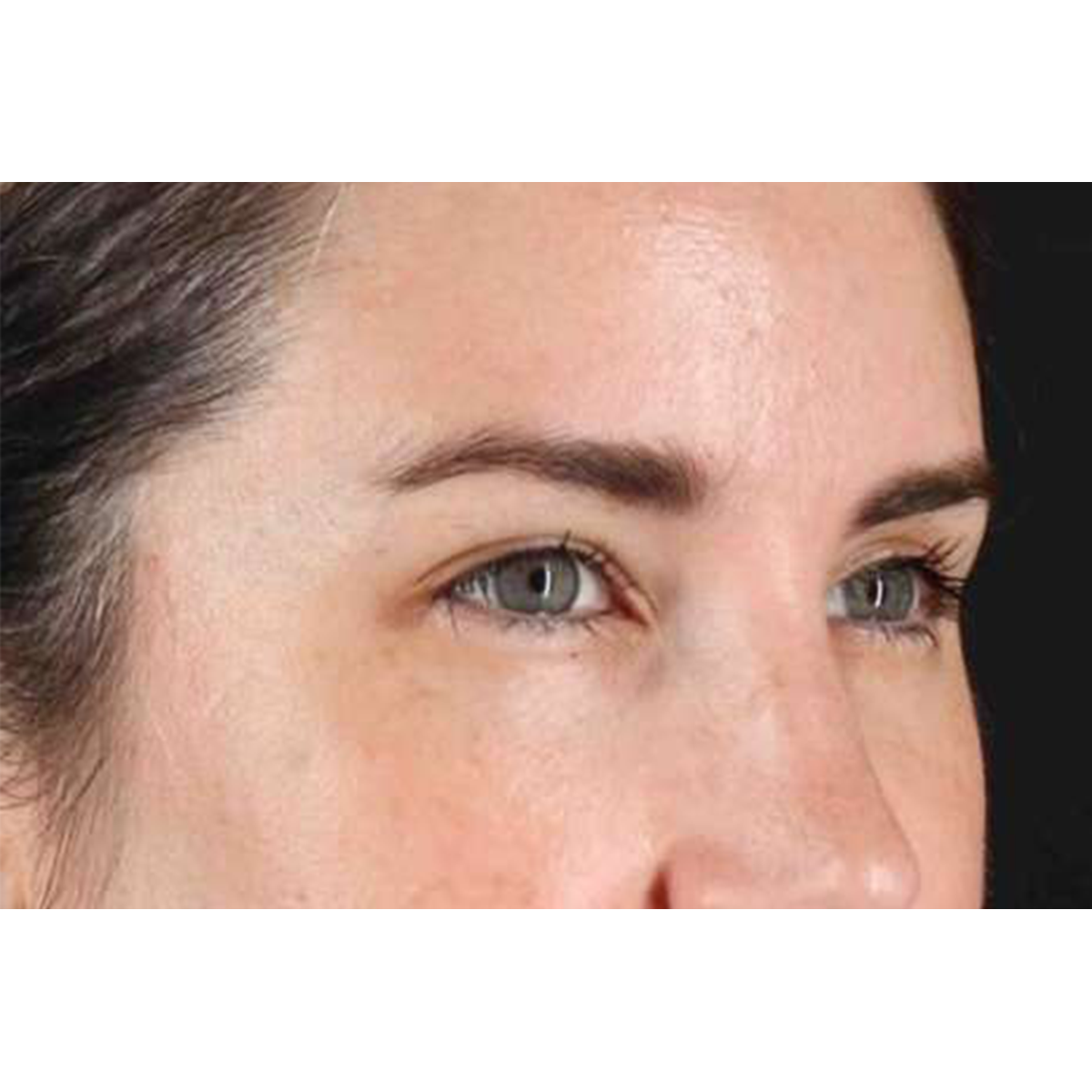 Brow Lift Before & After Patient #1599