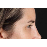 Brow Lift Before & After Patient #1599