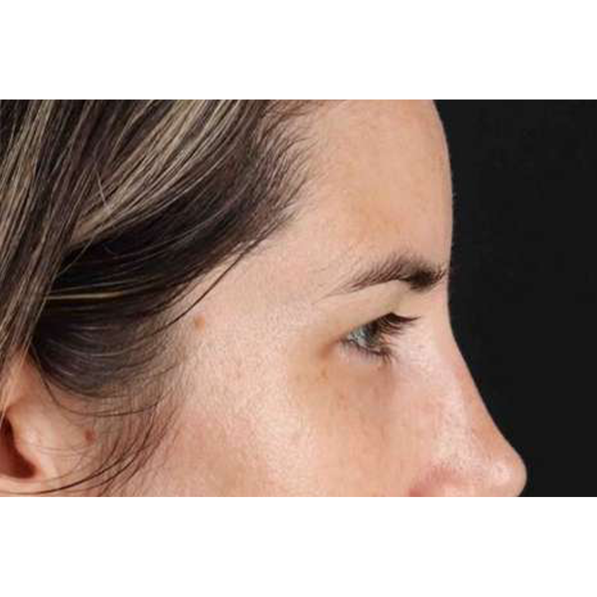 Brow Lift Before & After Patient #1599