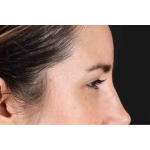 Brow Lift Before & After Patient #1599