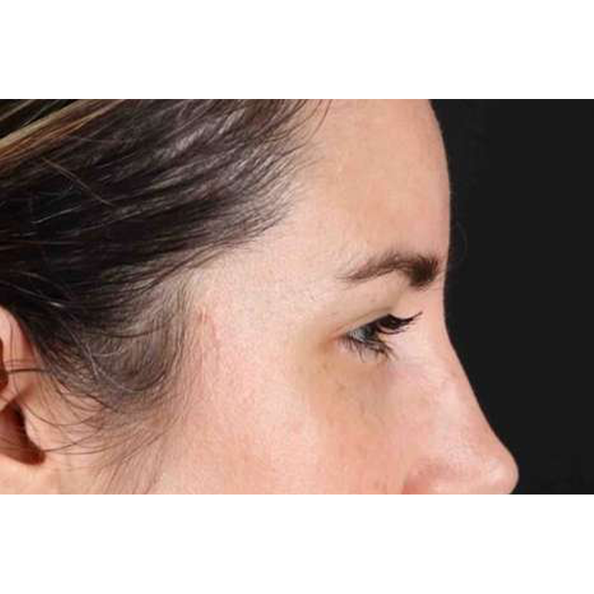 Brow Lift Before & After Patient #1599