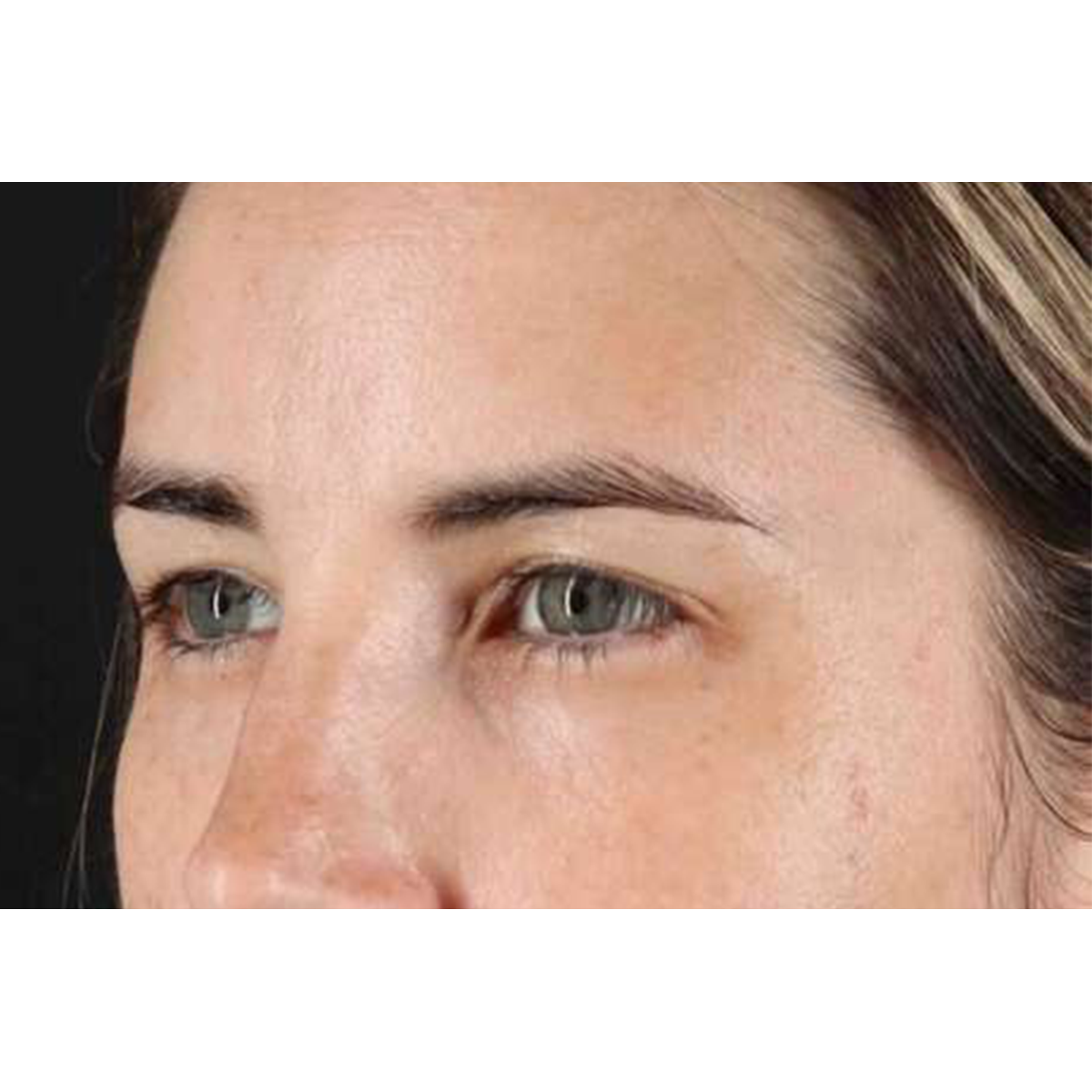 Brow Lift Before & After Patient #1599