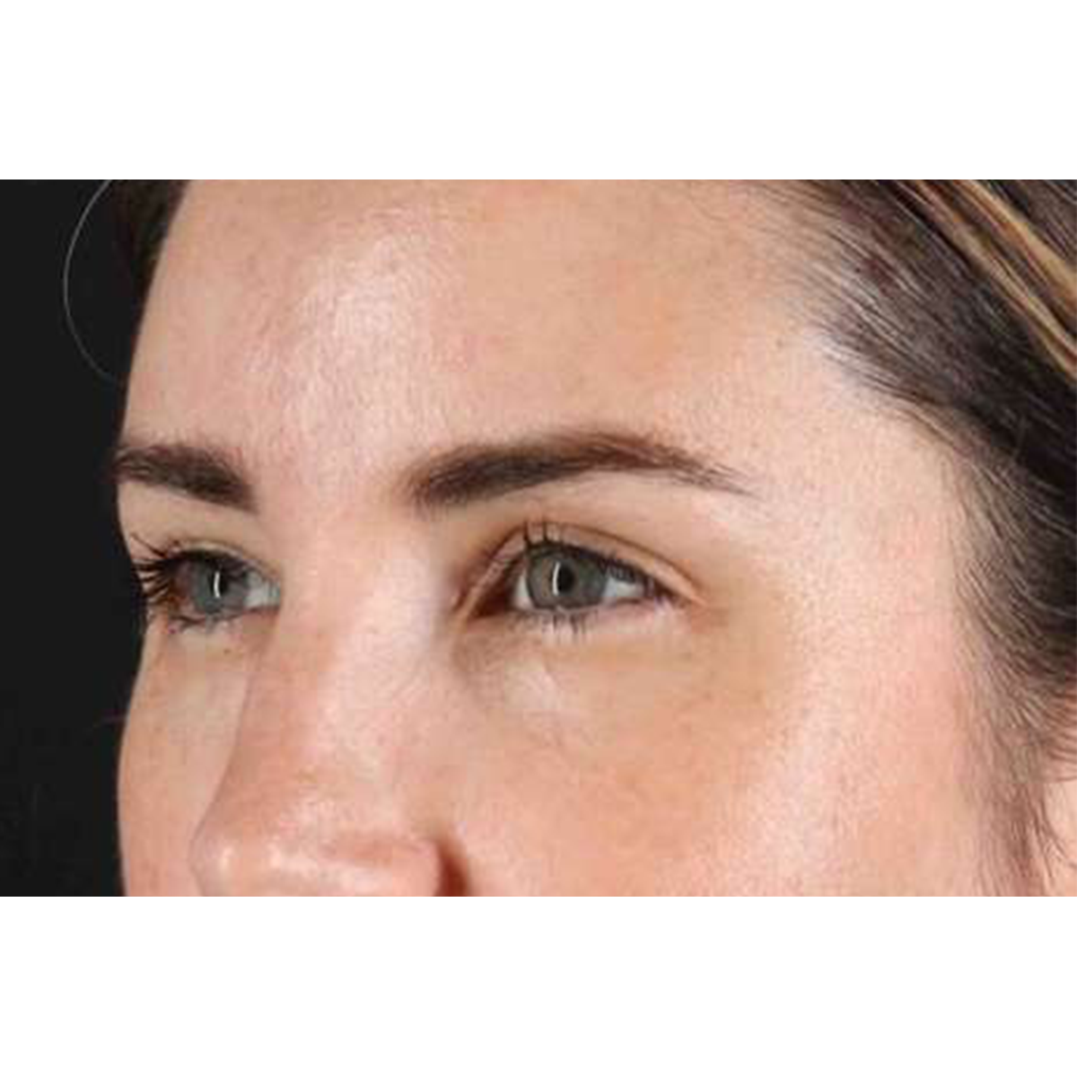 Brow Lift Before & After Patient #1599