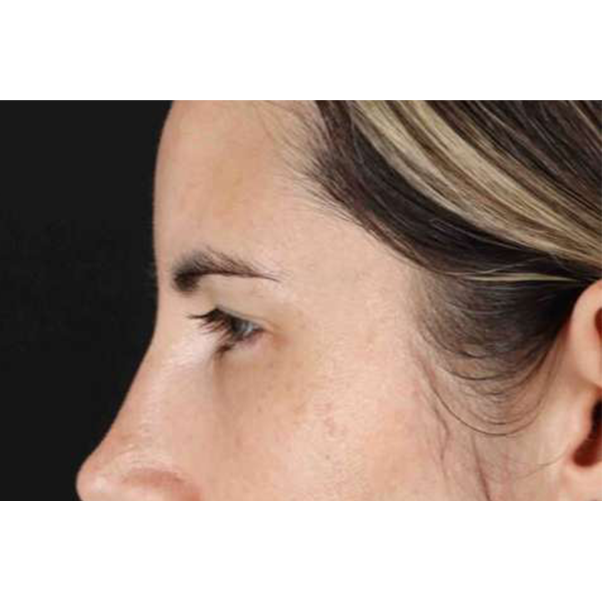 Brow Lift Before & After Patient #1599