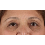 Eyelid Surgery Before & After Patient #1803