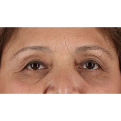 Eyelid Surgery Before & After Patient #1803