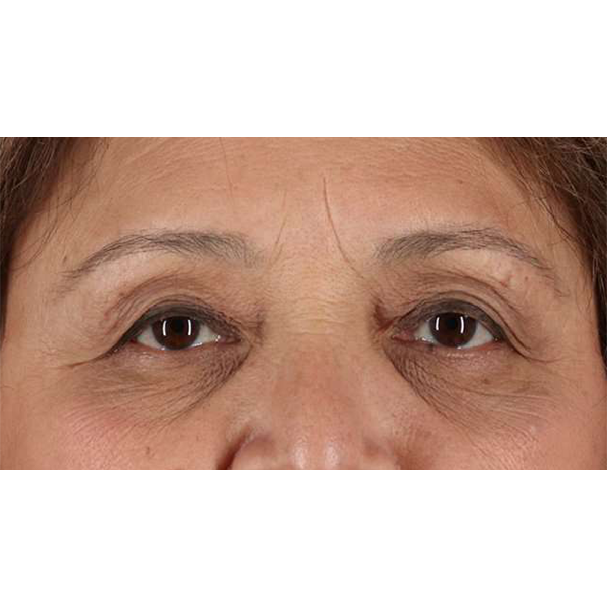 Eyelid Surgery Before & After Patient #1803