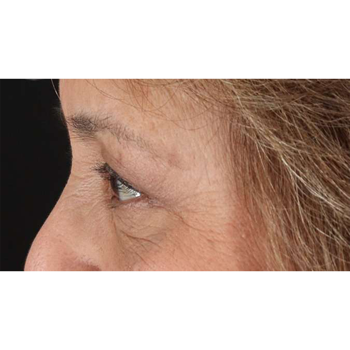 Eyelid Surgery Before & After Patient #1803