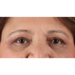 Eyelid Surgery Before & After Patient #1803