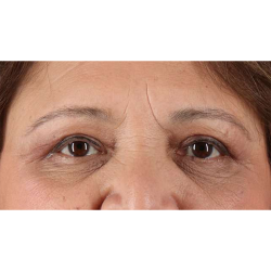 Eyelid Surgery Before & After Patient #1803