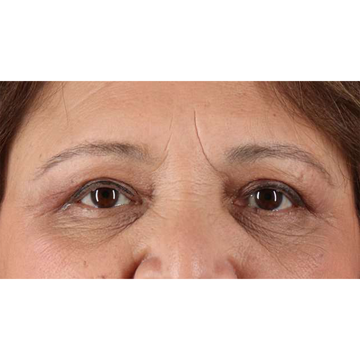 Eyelid Surgery Before & After Patient #1803