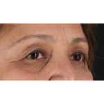 Eyelid Surgery Before & After Patient #1803