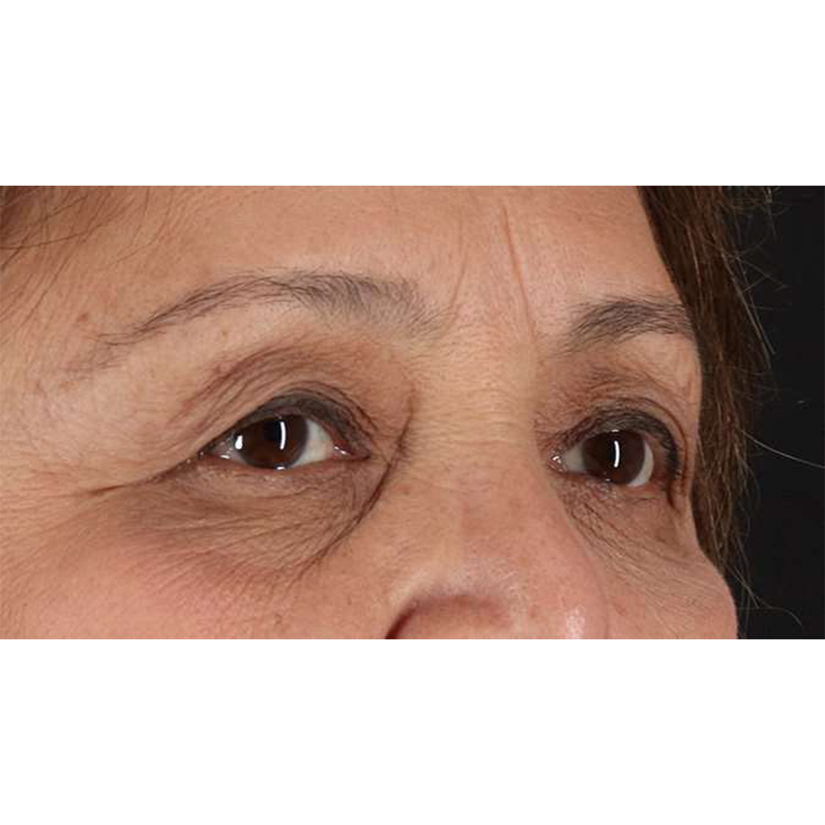 Eyelid Surgery Before & After Patient #1803