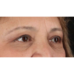 Eyelid Surgery Before & After Patient #1803