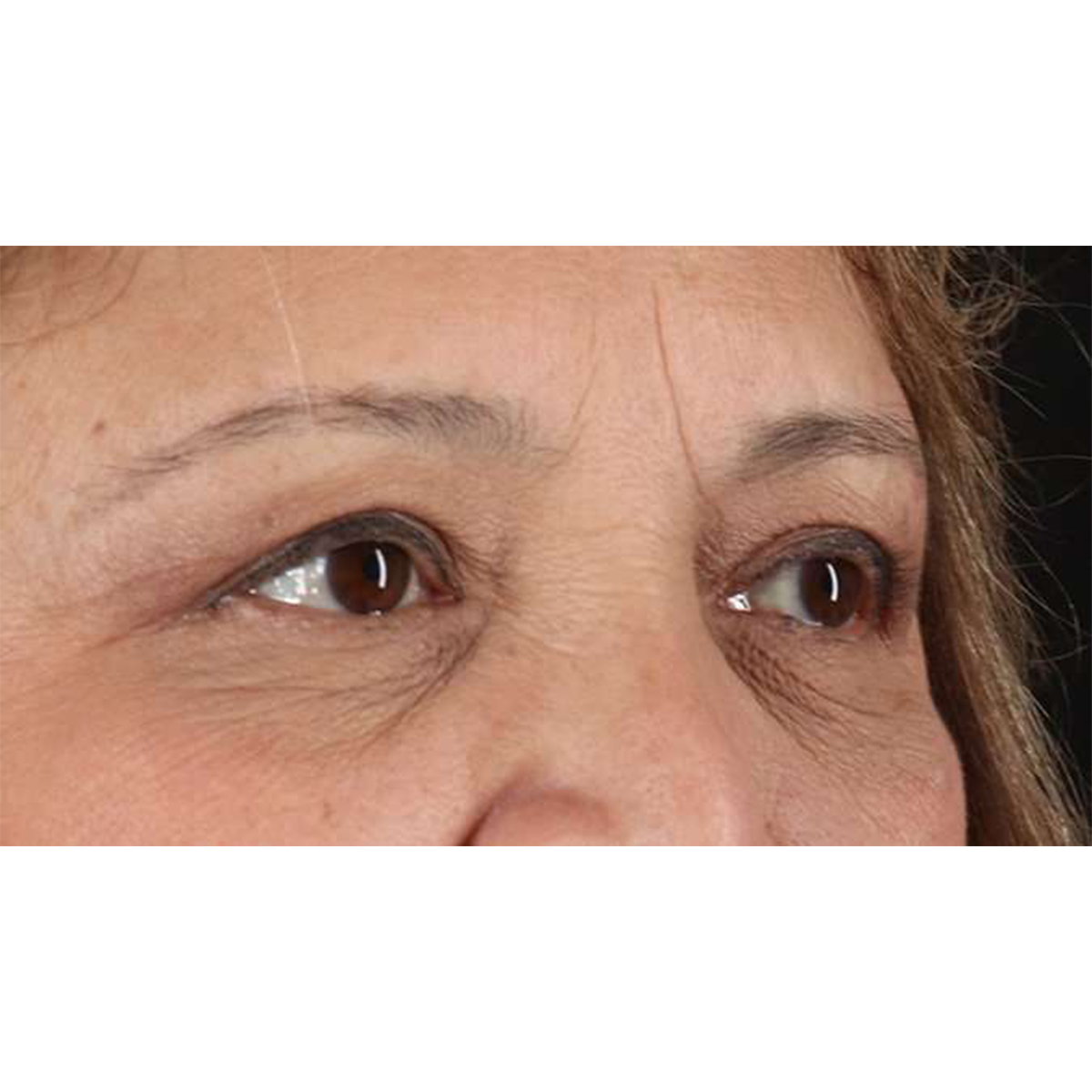 Eyelid Surgery Before & After Patient #1803